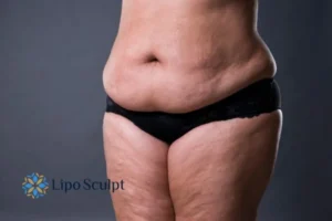 Cellulite's 5 Most Common Causes 4 Feel more confidence with your cellulite Wembley treatment today!