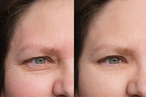 HIFU vs Botulinum Toxin: Understanding the Differences 4 How long do HIFU results last Wembley?