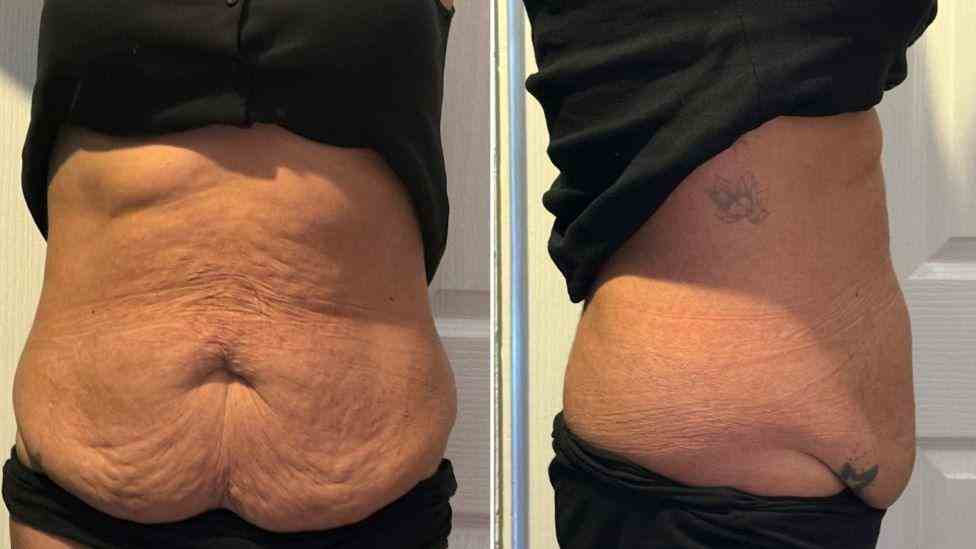 Lost the Weight but Not the Loose Skin? What You Should Know 1 Is It Definitely Loose Skin Wembley?